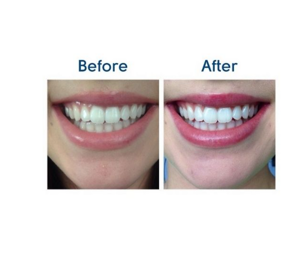 Thumbnail: DELUXE TAKE-HOME WHITENING KIT