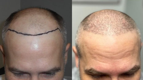Fort Worth Hair Transplant