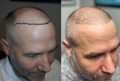 Fort Worth Hair Transplant