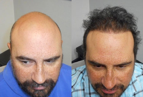 Fort Worth Hair Transplant