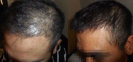 Fort Worth Hair Transplant