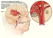 brain anuerysm dementia photo.webp