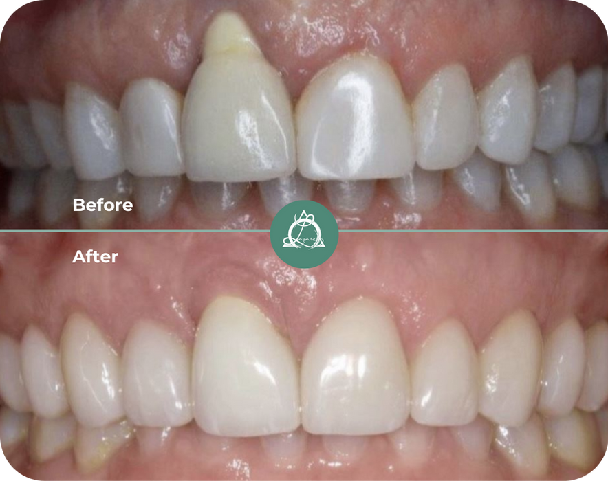 Smile transformation with 9 veneers and an implant crown enhanced with pink porcelain to mask a bone defect.
