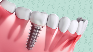 3D illustration of a dental implant integrated into the lower jawbone, showing the titanium post supporting a natural-looking crown between two healthy teeth. The background features a soft mint green color with a decorative Dr. Marc Lazare Branded swirl pattern.