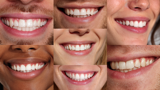 Close-up collage of healthy smiling mouths showing teeth and gums, highlighting different gum lines and oral health for a blog about gum recession.