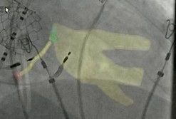 Proximal LB Trunk.jpg
