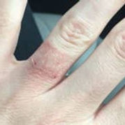 Finger with jewelry allergy. Make jewelery hypoallergenic. 