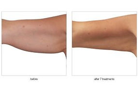 Cellulite reduction