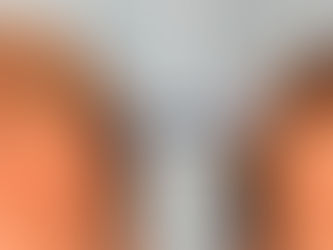 Hair Transplants: All Your Questions Answered