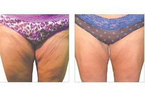 Cellulite reduction