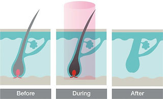 Elysion laser hair removal