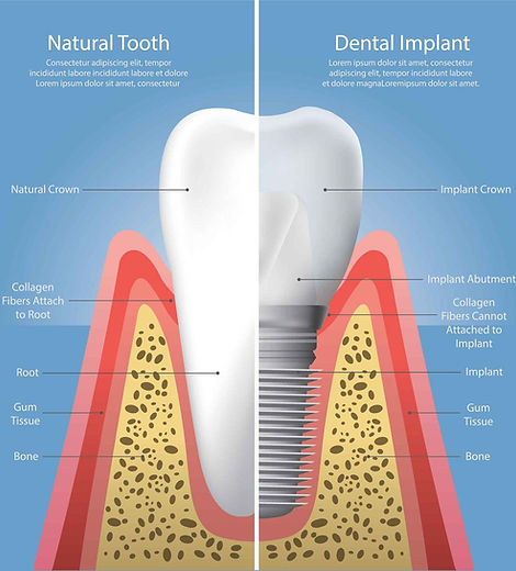 Implants
