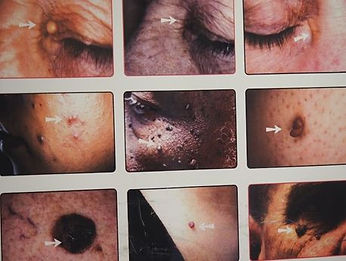 Skin Tags Removal