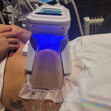 Our fat freezing treatment