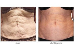 Cellulite reduction