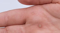 Warts /Verruca