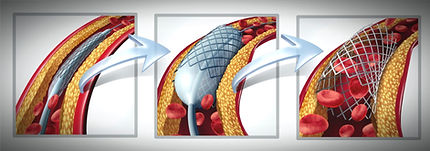 ANGIOPLASTY.jpg