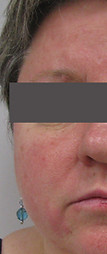 Lesions before