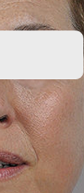 skin-rejuvination-after