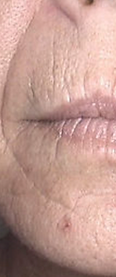 wrinkle-reduction-before-2