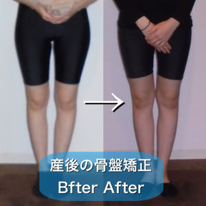 産後の骨盤矯正