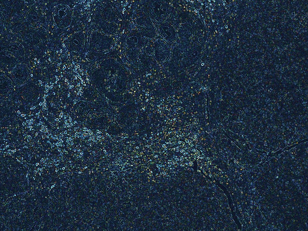 B cell infiltration (1).jpg