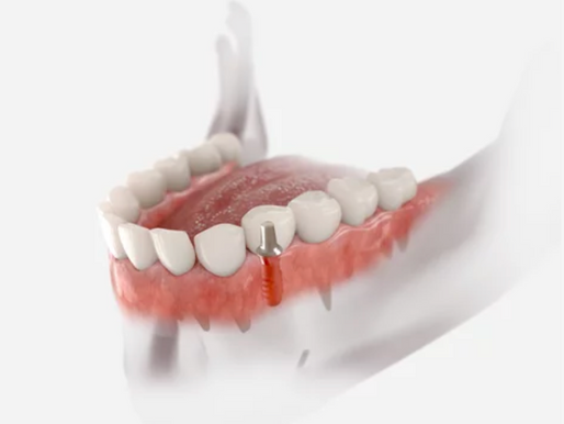 Implants dentaires : à qui s’adressent-ils ?