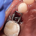 Space maintainers provided at Cheery Smiles Kids Dentisty after extraction of milk teeth