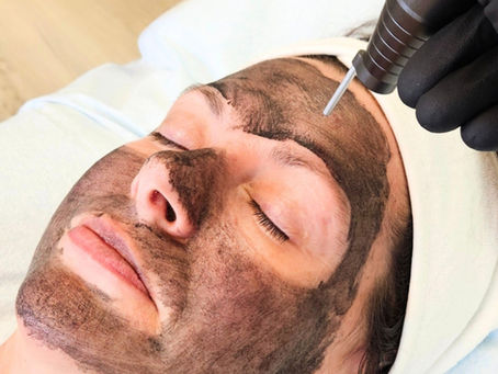 The Hollywood Carbon Peel
