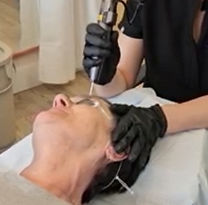 Collagen stimulation and pigetment reduction with Hollywood toning