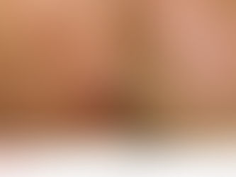 Before and after Melasma treatments with the Hollywood Spectra