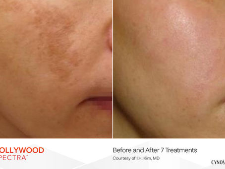 Before and after Melasma treatments with the Hollywood Spectra