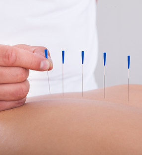 Acupuncture Therapy Session