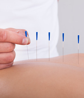 Acupuncture Therapy Session