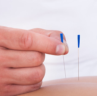 Acupuncture