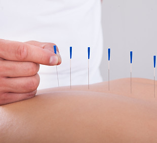 Acupuncture Therapy Session