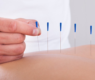 Acupuncture Needling
