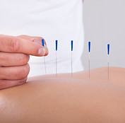 Acupuncture therapy session