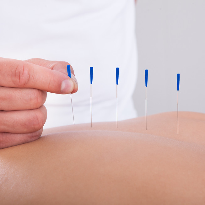 Acupuncture Therapy Session