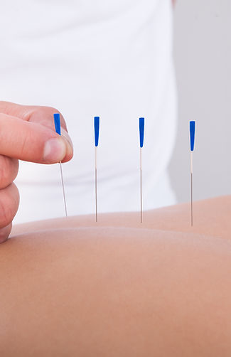 acupuntura