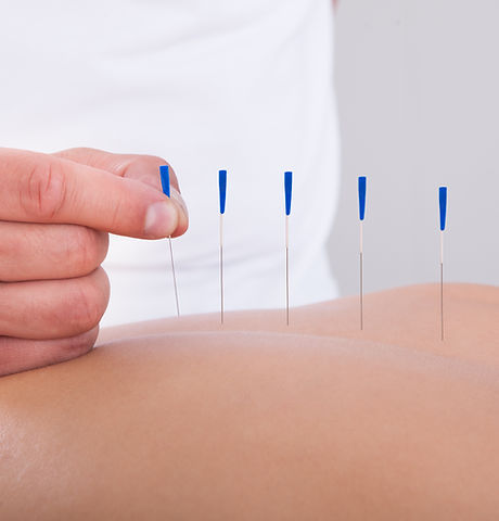 Acupuncture