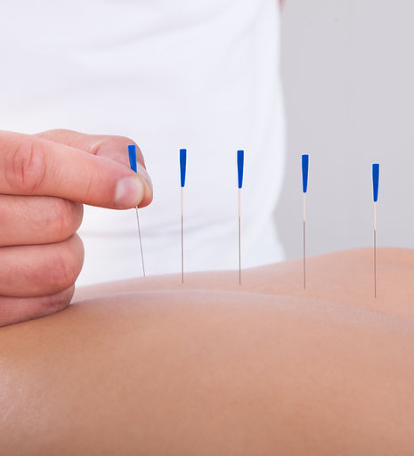 Acupuncture Therapy Session