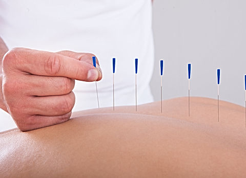 Dry needling