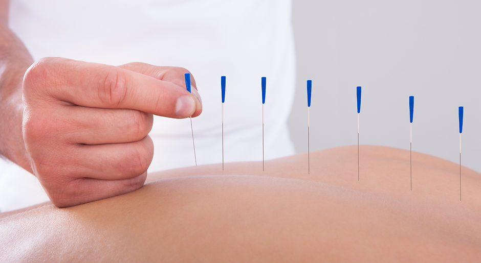 acupuntura