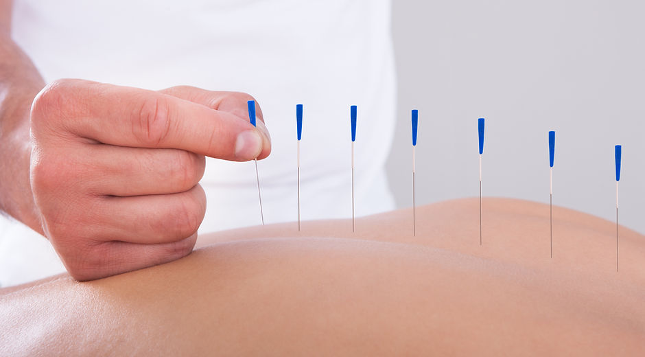 Acupuncture