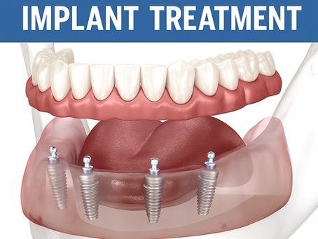 What Is the All-on-4 Dental Implant Treatment and Why So Many Patients Choose Puerto Vallarta