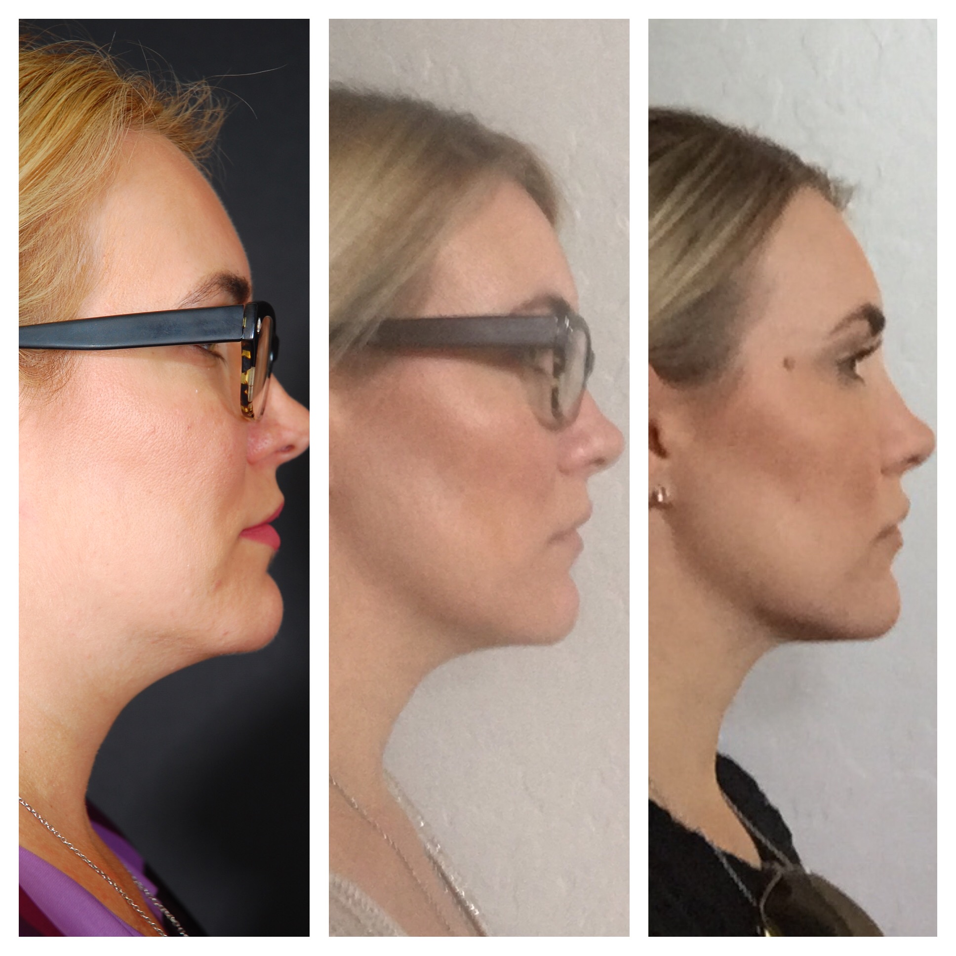 Kybella