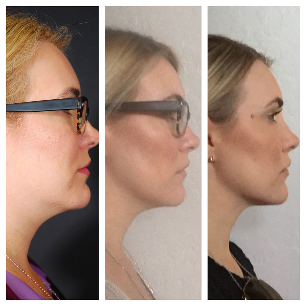 Kybella