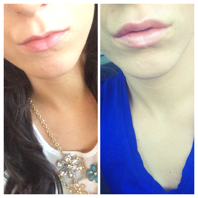 Restylane Lip Filler