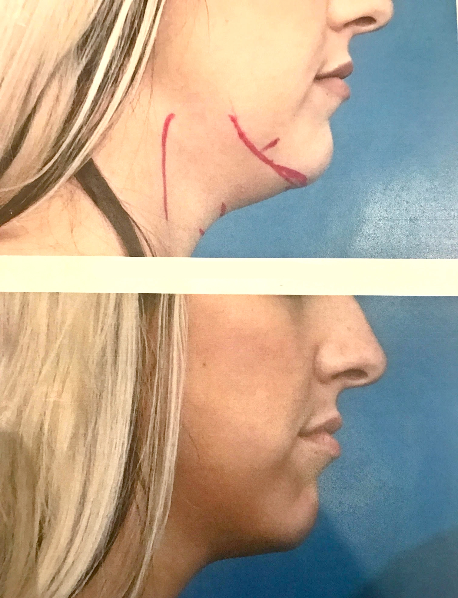 Kybella